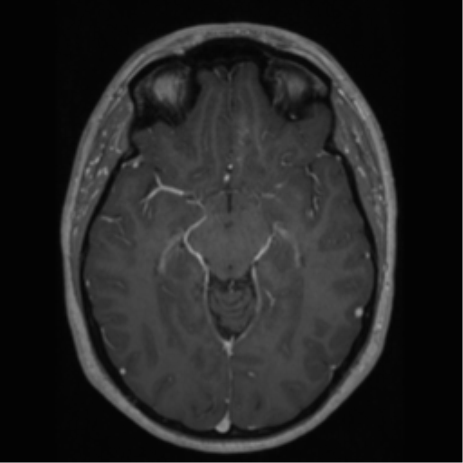 Cerebral cavernoma and development venous anomaly (Radiopaedia 37603-39482 Axial T1 C+ 33).png