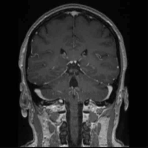 Cerebral cavernoma and development venous anomaly (Radiopaedia 37603-39482 Coronal T1 C+ 38).png