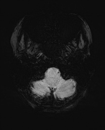 Cerebral cavernous venous malformation (Radiopaedia 70008-80021 Axial SWI 5).jpg