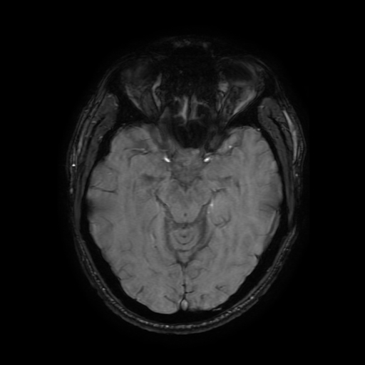 Cerebral cavernous venous malformation (Zabramski type II) (Radiopaedia 85511-101198 Axial SWI 54).jpg