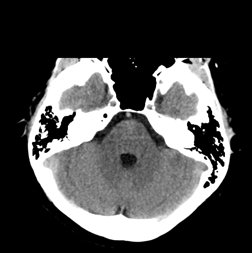 File:Cerebral cavernous venous malformations (Radiopaedia 48117-52945 Axial non-contrast 10).png