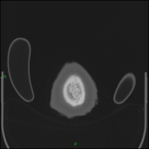 Cerebral contusions (Radiopaedia 33868-35039 Axial bone window 224).jpg