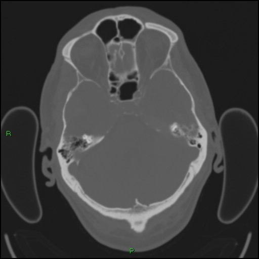 Cerebral contusions (Radiopaedia 33868-35039 Axial bone window 57).jpg