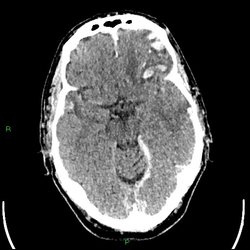 Cerebral contusions (Radiopaedia 33868-35039 Axial non-contrast 80).jpg