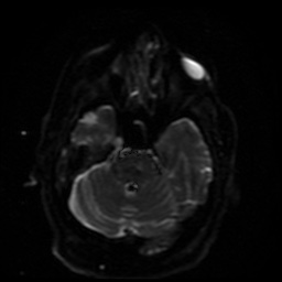 Cerebral embolic infarcts (embolic shower) (Radiopaedia 49837-55108 Axial DWI 35).jpg