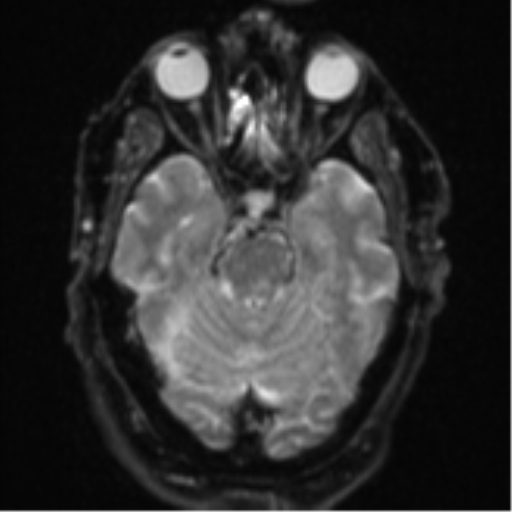 File:Cerebral embolic infarcts (embolic shower) (Radiopaedia 57395-64342 Axial DWI 12).png