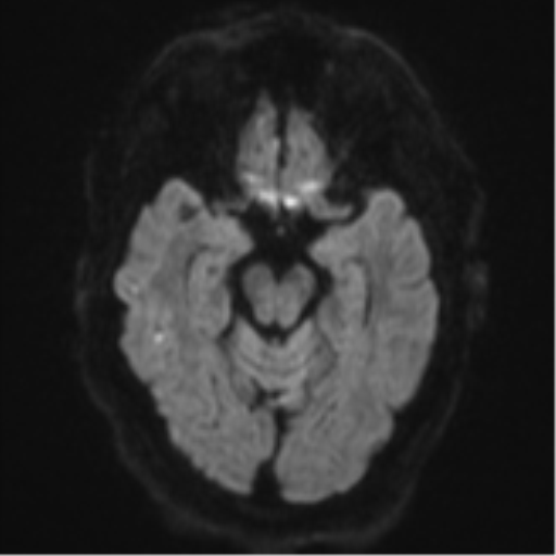 File:Cerebral embolic infarcts (embolic shower) (Radiopaedia 57395-64342 Axial DWI 50).png