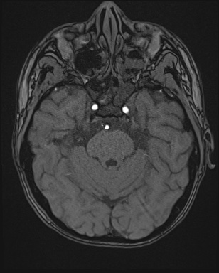 File:Cerebral embolic infarcts (embolic shower) (Radiopaedia 72391-82921 Axial MRA 40).jpg