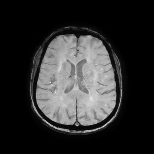 Cerebral metastases - melanoma (Radiopaedia 80972-94522 Axial SWI 60).jpg