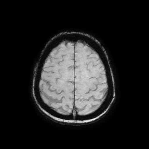 File:Cerebral metastases - melanoma (Radiopaedia 80972-94522 Axial SWI 79).jpg
