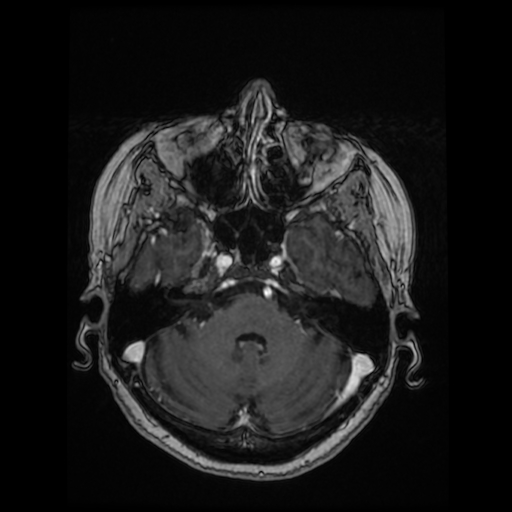 Cerebral metastases - melanoma (Radiopaedia 80972-94522 Axial T1 C+ 37).jpg