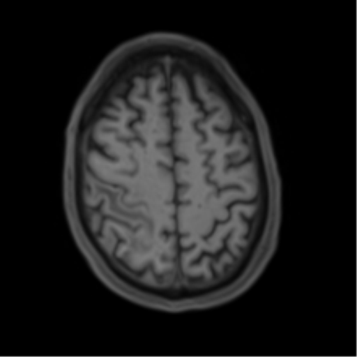 Cerebral metastasis - melanoma (Radiopaedia 54718-60954 Axial T1 42).png