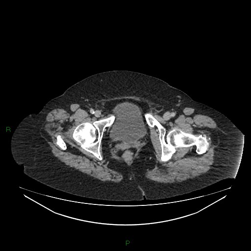 Cerebral metastasis from renal cell carcinoma (Radiopaedia 82306-96378 A 187).jpg