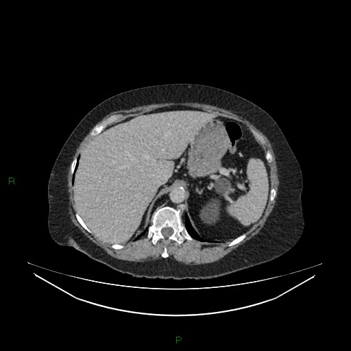 Cerebral metastasis from renal cell carcinoma (Radiopaedia 82306-96378 A 36).jpg