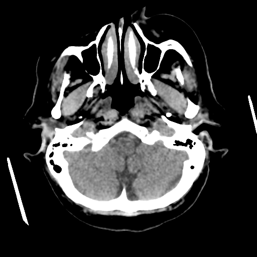 Cerebral metastasis to basal ganglia (Radiopaedia 81568-95412 Axial non-contrast 14).png