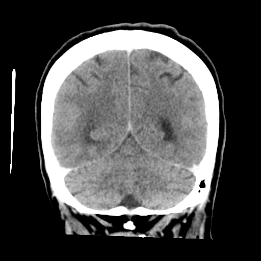 Cerebral metastasis to basal ganglia (Radiopaedia 81568-95412 Coronal C+ delayed 47).png