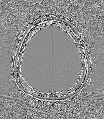Cerebral metastasis to basal ganglia (Radiopaedia 81568-95413 Axial SWI phase 71).png
