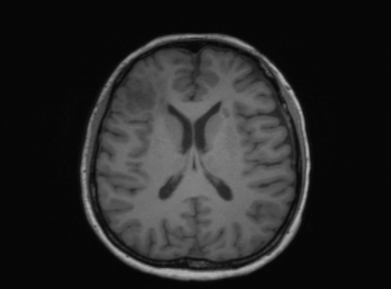 Cerebral ring enhancing lesions - cerebral metastases (Radiopaedia 44922-48817 Axial T1 205).jpg