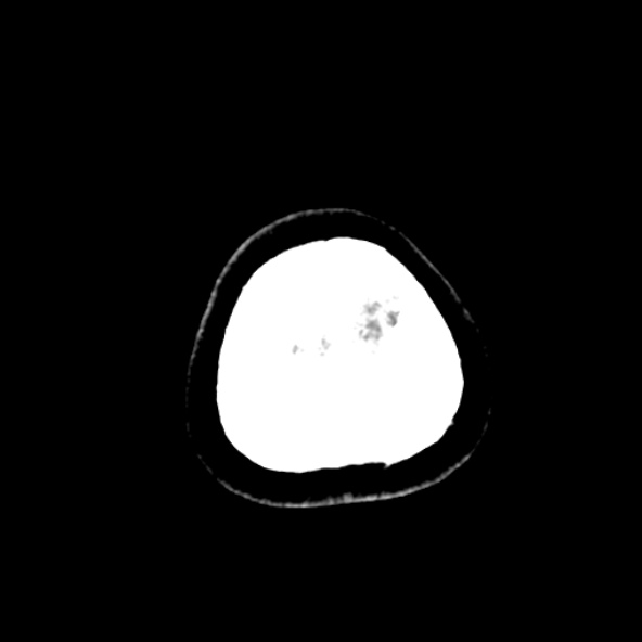 Cerebral ring enhancing lesions - cerebral metastases (Radiopaedia 44922-48818 Axial non-contrast 109).jpg