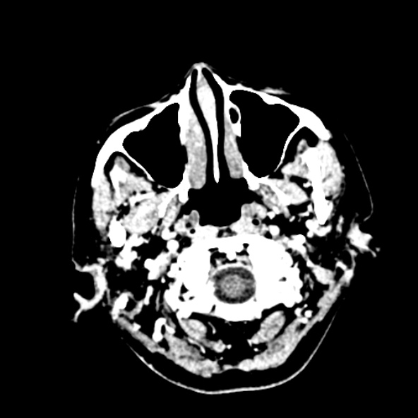 File:Cerebral ring enhancing lesions - cerebral metastases (Radiopaedia 44922-48818 B 17).jpg