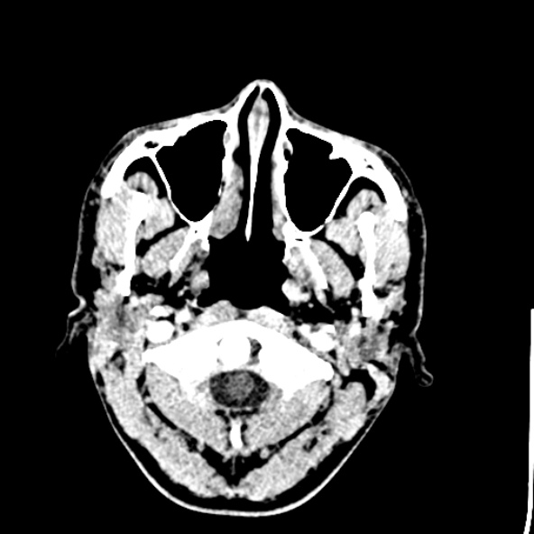 Cerebral toxoplasmosis (Radiopaedia 53993-60131 Axial C+ delayed 1).jpg