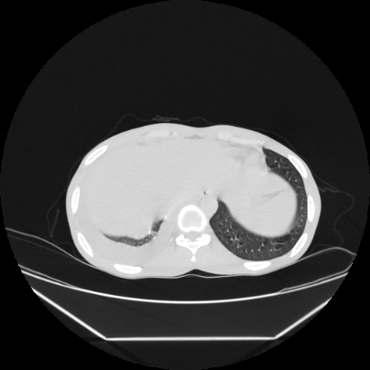 Cerebral tuberculoma (Radiopaedia 80829-94318 Axial lung window 163).jpg
