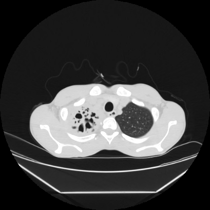Cerebral tuberculoma (Radiopaedia 80829-94318 Axial lung window 18).jpg