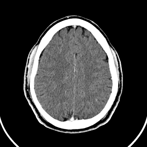 Cerebral venous angioma (Radiopaedia 69959-79977 B 73).jpg
