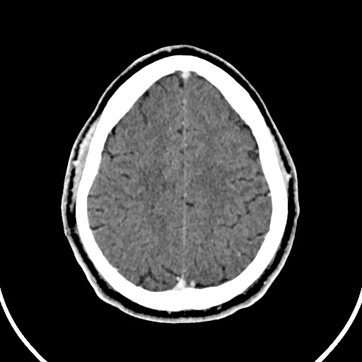 Cerebral venous angioma (Radiopaedia 69959-79977 B 81).jpg