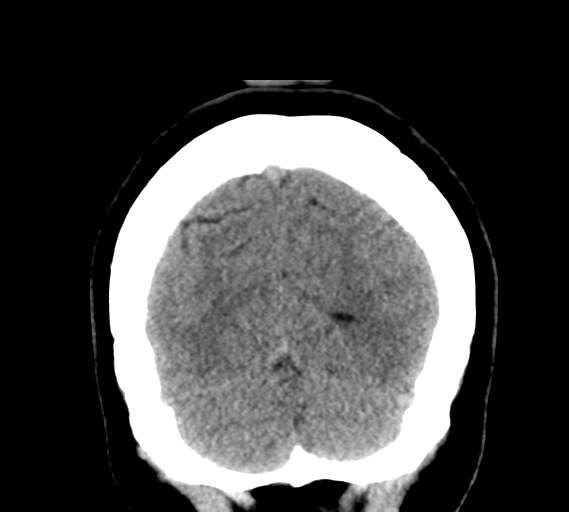 File:Cerebral venous infarct related to dural venous sinus thromboses (Radiopaedia 35292-36804 Coronal non-contrast 31).png