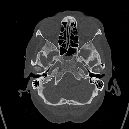 Cerebral venous infarction with hemorrhage (Radiopaedia 65343-74381 Axial bone window 17).jpg