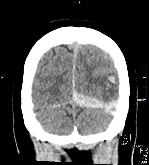 File:Cerebral venous sinus thrombosis (Radiopaedia 91329-108965 Coronal non-contrast 50).jpg