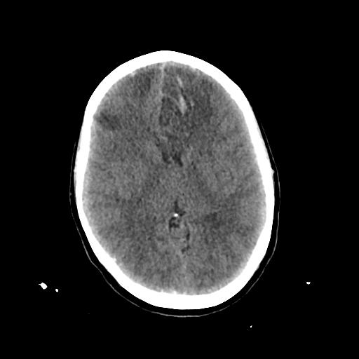 Cerebral venous throbmosis - hemorrhagic venous infarction (Radiopaedia 87318-103613 Axial non-contrast 84).jpg