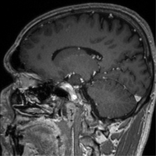 Cerebral venous thrombosis (Radiopaedia 38392-40469 Sagittal T1 C+ 38).png