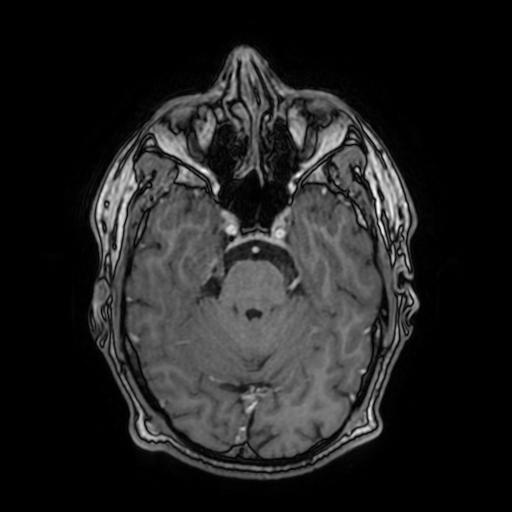 File:Cerebral venous thrombosis with secondary intracranial hypertension (Radiopaedia 89842-106957 Axial T1 C+ 67).jpg