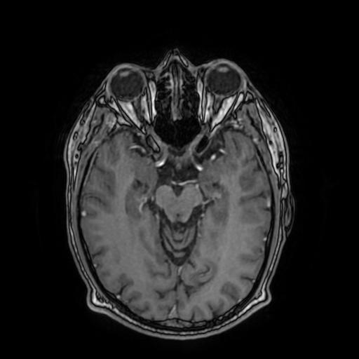 Cerebral venous thrombosis with secondary intracranial hypertension (Radiopaedia 89842-106957 Axial T1 C+ 81).jpg