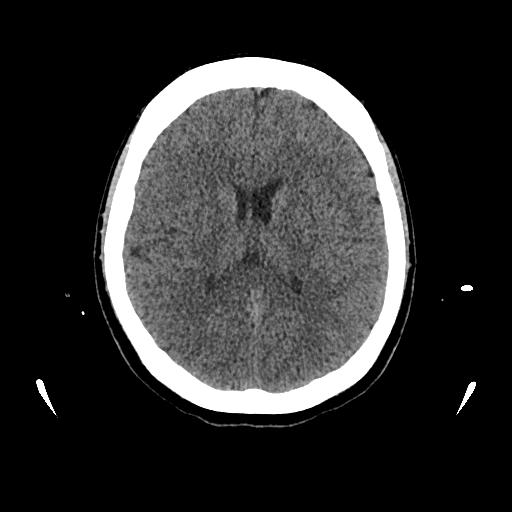 Cerebral venous thrombosis with venous hemorrhagic infarct (Radiopaedia 90354-107660 Axial non-contrast 30).jpg