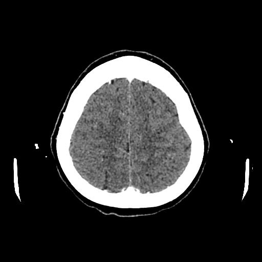 Cerebral venous thrombosis with venous hemorrhagic infarct (Radiopaedia 90354-107660 Axial with contrast 134).jpg
