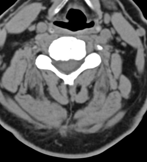 File:Cervical canal stenosis due to ossification of the posterior longitudinal ligament (Radiopaedia 47260-51823 Axial non-contrast 32).png