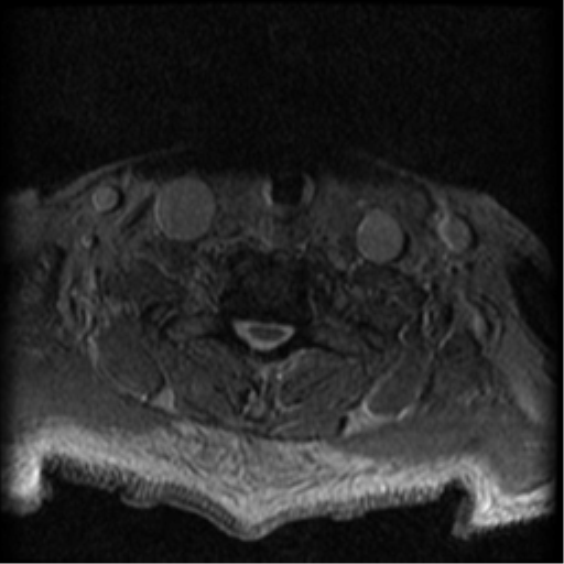 Cervical canal stenosis with cord compression (Radiopaedia 34114-35374 Axial Gradient Echo 20).png