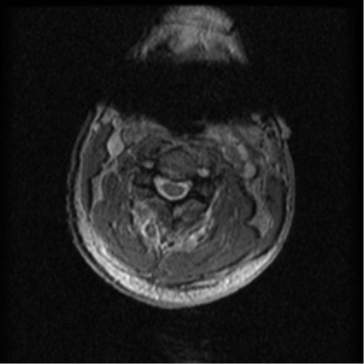 Cervical canal stenosis with cord compression (Radiopaedia 34114-35374 Axial Gradient Echo 69).png