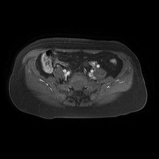 File:Cervical carcinoma (Radiopaedia 67644-77047 Axial T1 C+ fat sat 5).jpg