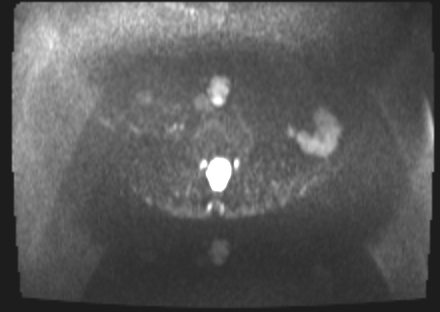 File:Cervical carcinoma (Radiopaedia 88312-104943 Axial DWI 2).jpg