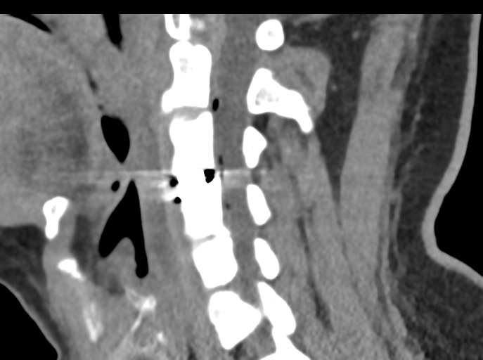 File:Cervical disc replacement (Radiopaedia 44025-47541 B 56).png