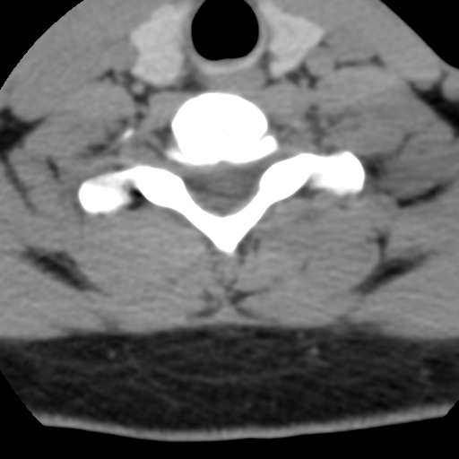Cervical schwannoma (Radiopaedia 57979-64974 Axial non-contrast 50).png