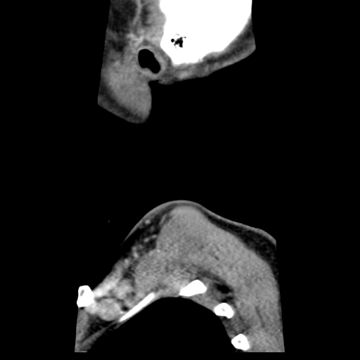 Cervical schwannoma (Radiopaedia 57979-64974 H 58).png