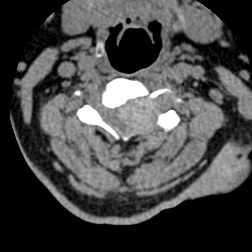 File:Cervical spinal neurofibroma in a patient with NF1 (Radiopaedia 58344-65464 Axial non-contrast 35).jpg