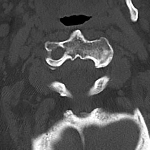 File:Cervical spine fracture - chalk stick (Radiopaedia 39116-41323 Axial bone window 21).png