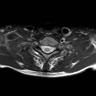 File:Cervical spine posterior ligamentous complex rupture (Radiopaedia 63486-72103 Axial T2 3).jpg