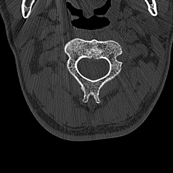Cervical spondylodiscitis (Radiopaedia 28057-29489 Axial bone window 25).jpg